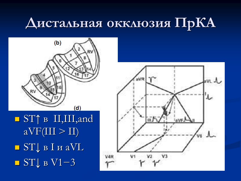 Дистальная окклюзия ПрКА ST↑ в  II,III,and aVF(III > II) ST↓ в I и